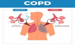 Hướng Dẫn Điều Trị COPD